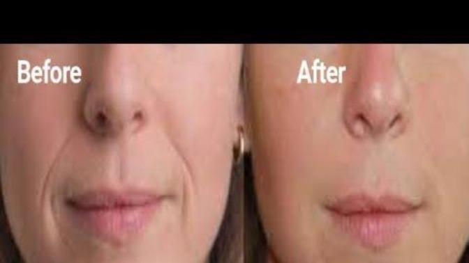 Should I get filler for my laugh lines or is it risky? Has anyone here gotten these fillers before?