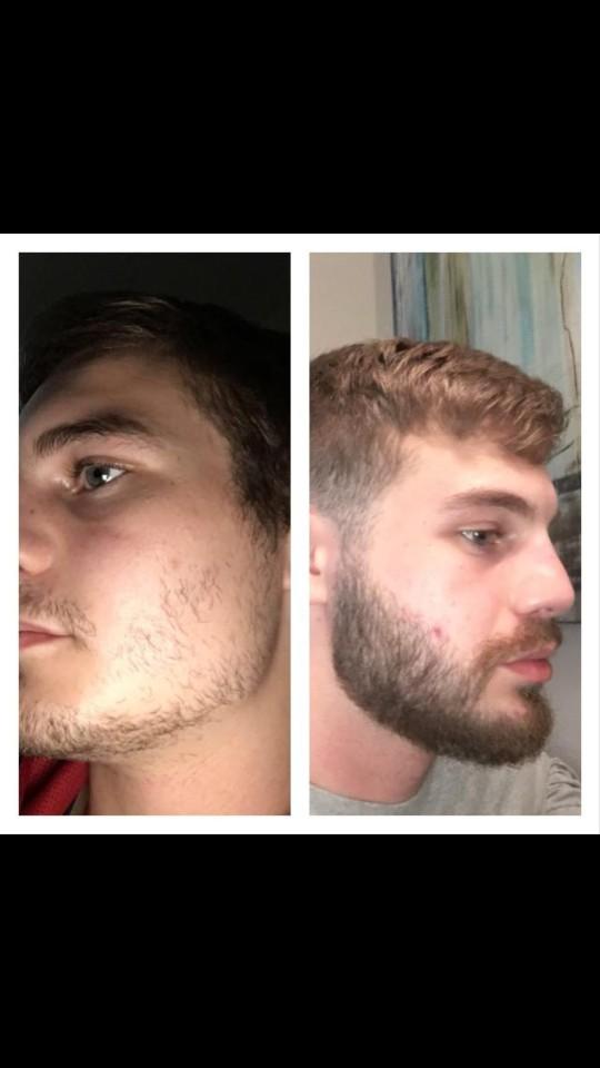 Does anyone have any experience using minoxidil?