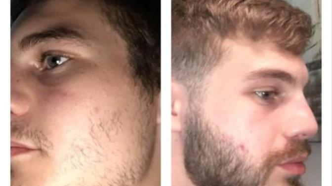 Does anyone have any experience using minoxidil?