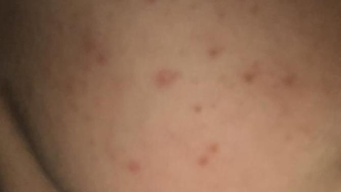 Why do I keep breaking out in certain areas? what else could I do to reduce or stop it?