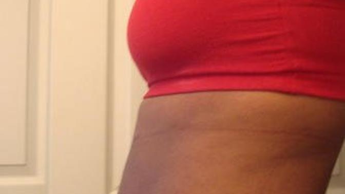 Would you date/marry a girl who had stretch marks on her body?