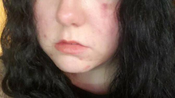 Battling acne as an adult?