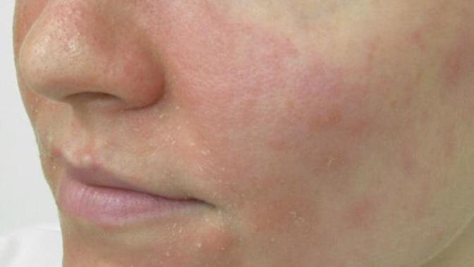 Do anyone has eczema? How did you recover?