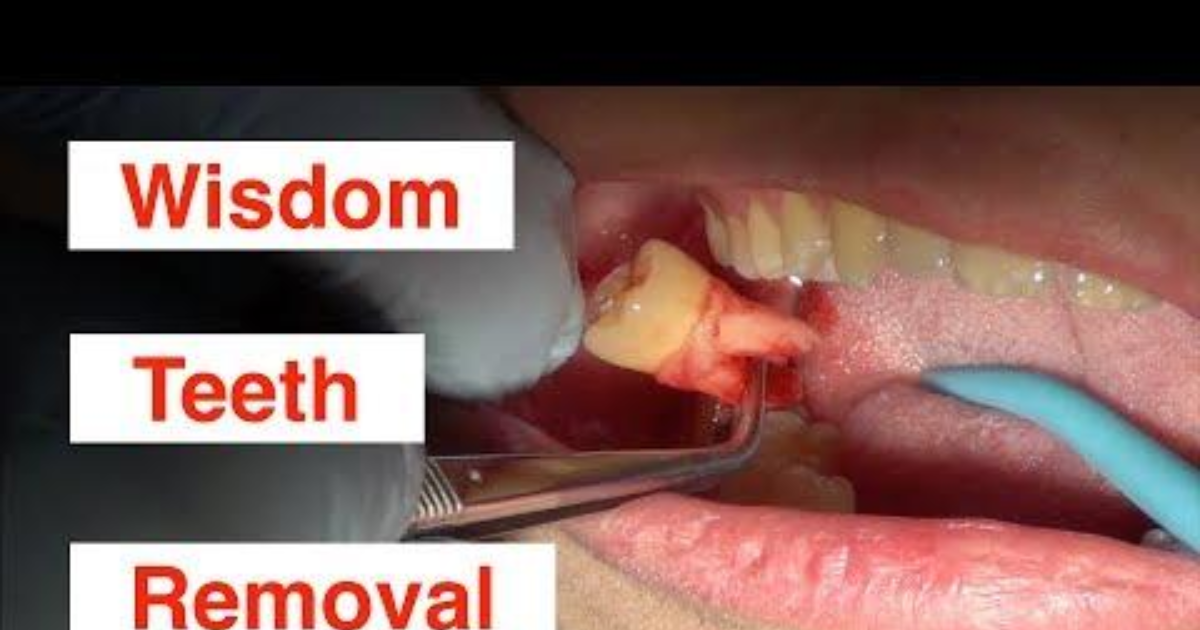 I have 2 wisdom teeth on left side of my jaw but I am too scared to get