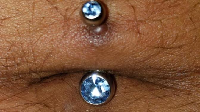 Is this a keloid or something else? Can it be healed?