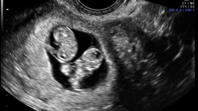 How am I going to tell the father as we have broken up recently? Don't know what to do?