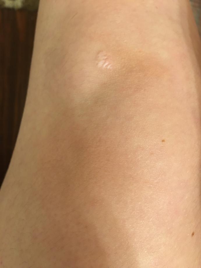 No, it’s not a birthmark. But a wound/scar