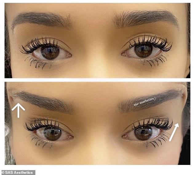 fox eye surgery