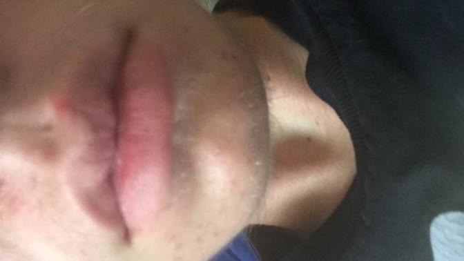 Is this a cold sore?
