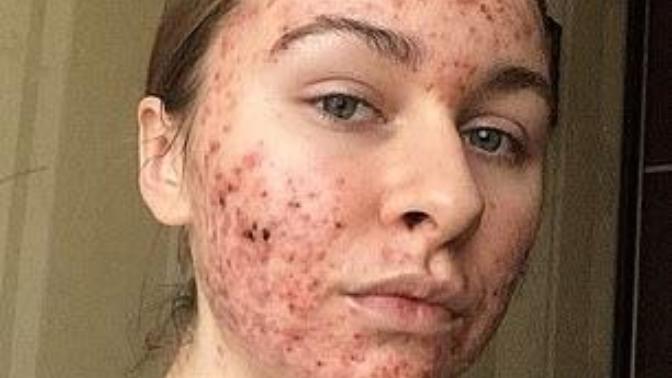 Does This Girl's Acne Make Her Unattractive?