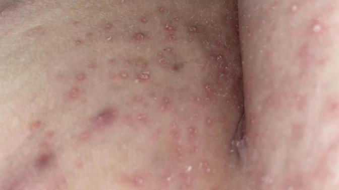 What is this rash?