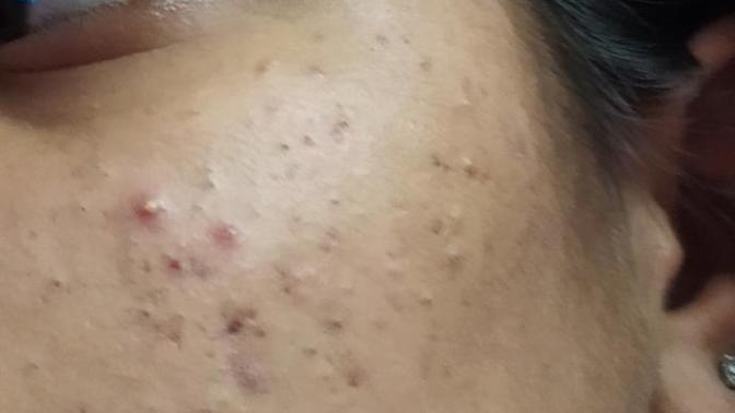 How to treat acne and acne marks naturally?