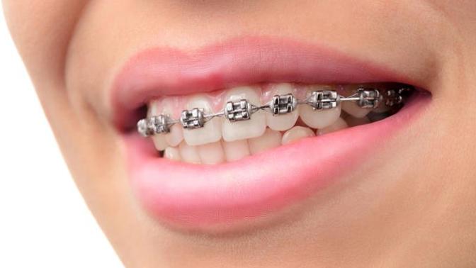 Unless your teeth are totally wrecked, are braces a good investment or a waste of money? Do they magically make your teeth perfect?