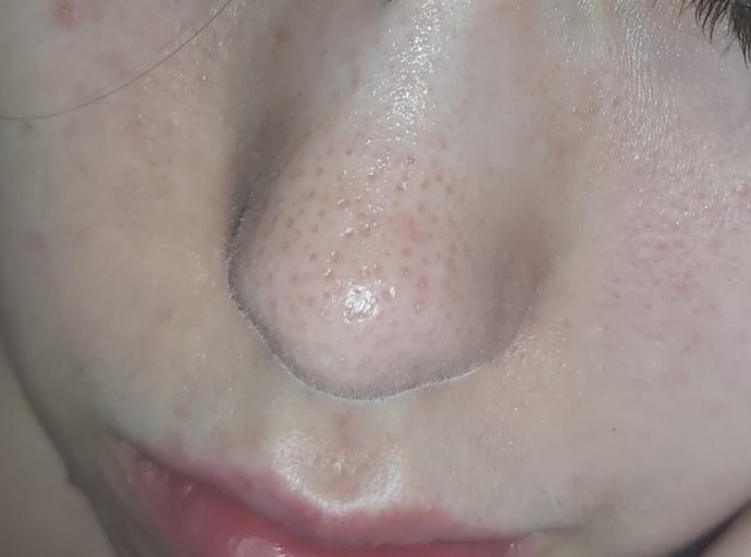Are these sebaceous filaments?