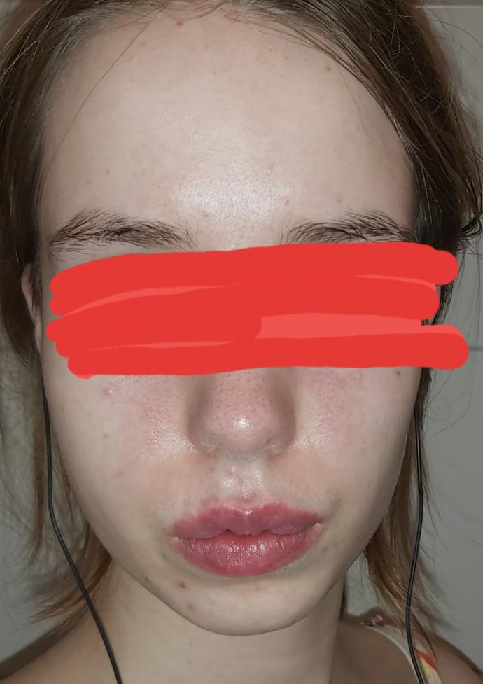 Or are these blackheads?