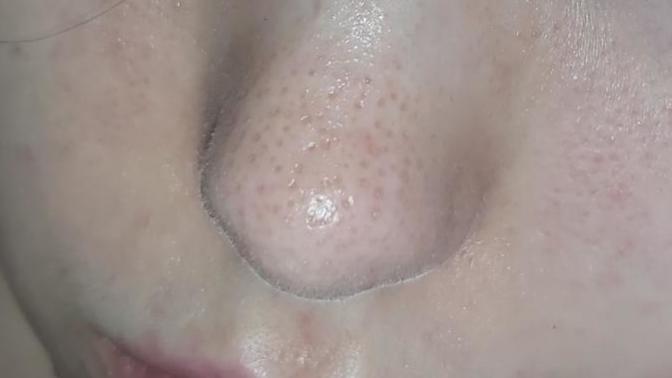 Can sebaceous filaments be this large or are these blackheads?