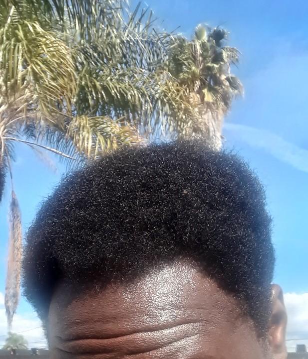 Should I go bald?