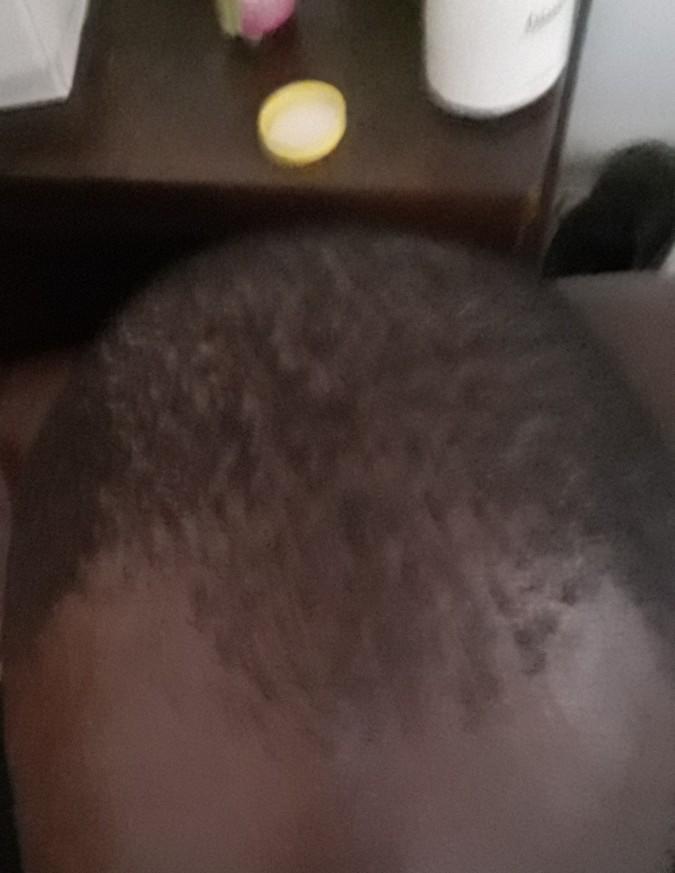 Should I go bald?