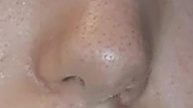 How can I start to accept my ugly skin?