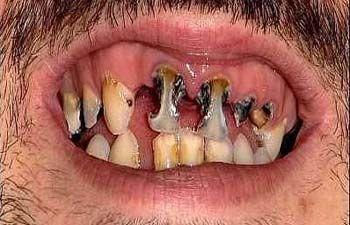 Would you date someone with bad teeth?