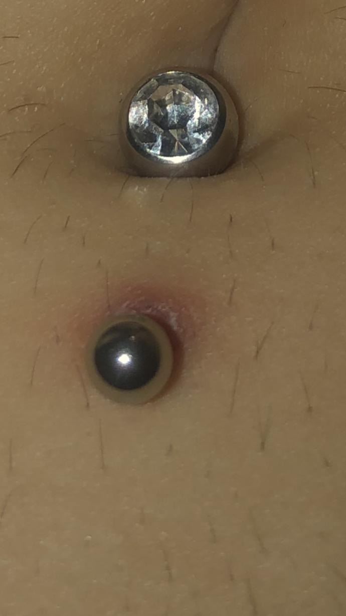 Belly piercing healing or infected? - GirlsAskGuys