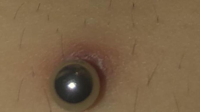 Belly piercing healing or infected?