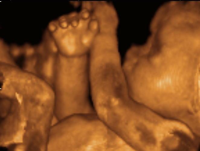 Are you aware that the life of the unborn is not part of the pregnant womans body but is anothers body other than hers?