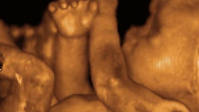 Are you aware that the life of the unborn is not part of the pregnant woman's body but is another's body other than hers?