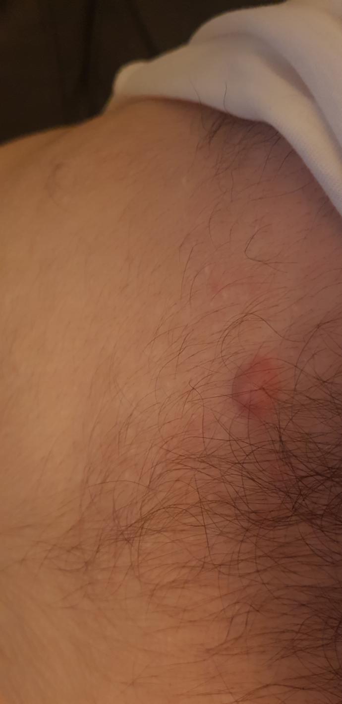 Recently found out I have a small spot/lump on my chest it has no head and is painless can anyone tell me what it is please?