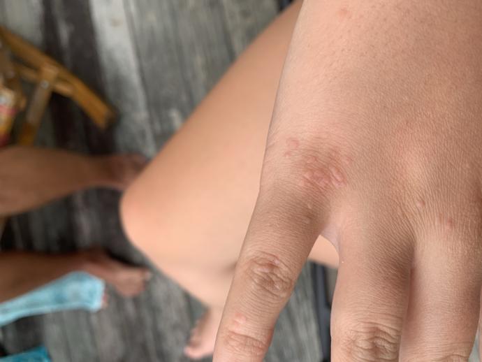 Warts on hands?