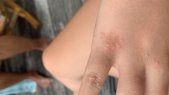 Warts on hands?