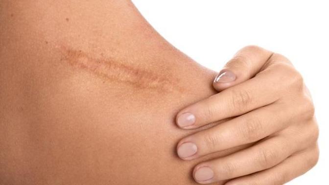 What is the best way to get rid of scars?