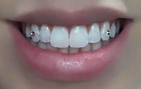 Should I get a tooth gem?