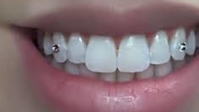 Should I get a tooth gem?