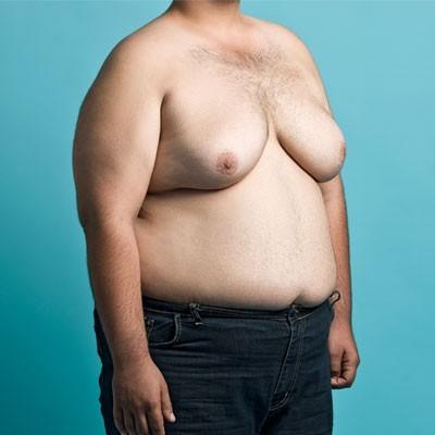 Ladies would you date a man that has gynecomastia?