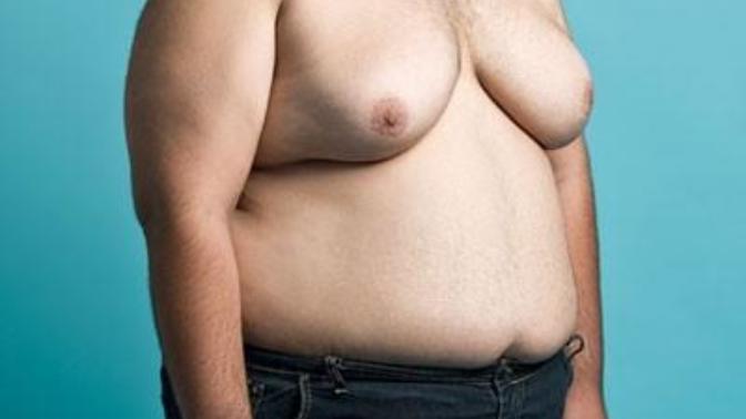 Ladies would you date a man that has gynecomastia?