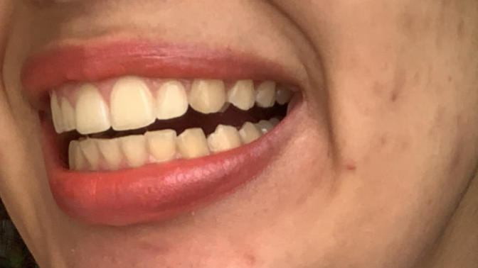 How to get whiter teeth 😭?