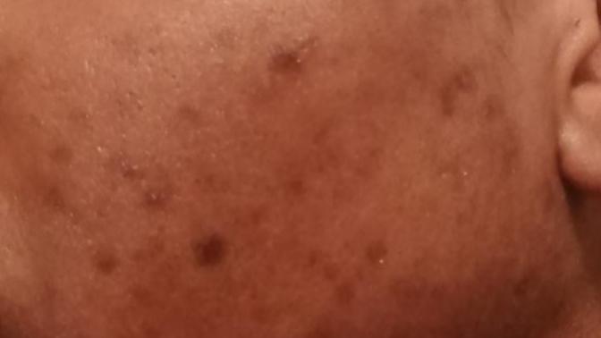 Do you suffer from hyperpigmentation? *sensitive content *?