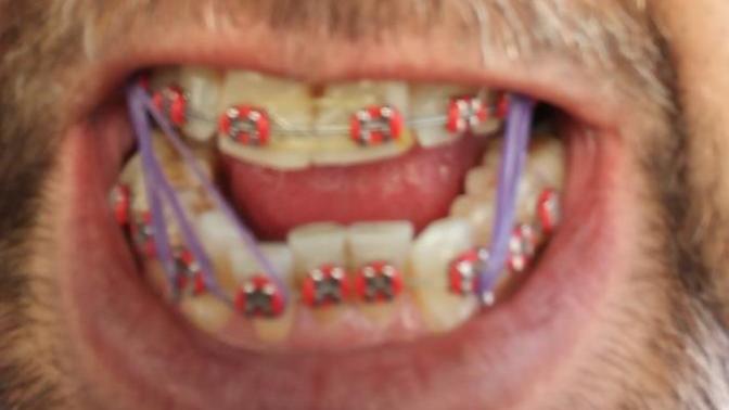 Would a women find a guy attractive with braces like mine?