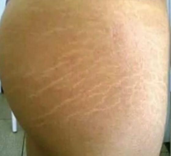 Do guys care about stretch marks?