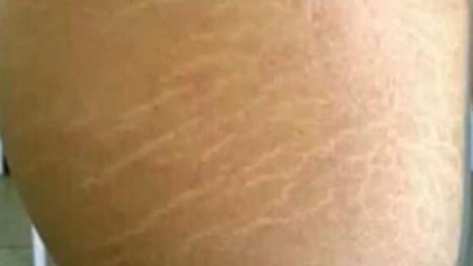 Do guys care about stretch marks?