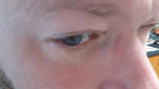 Why is my face always red?