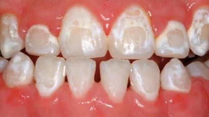 Can my teeth still become pearly whites?