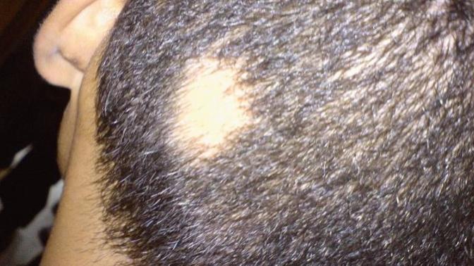Is men having long hair a cause of alopecia?