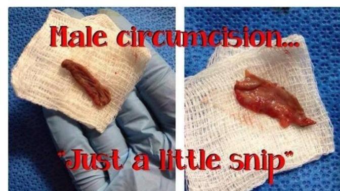 Is Female circumcision the same as male circumcision?