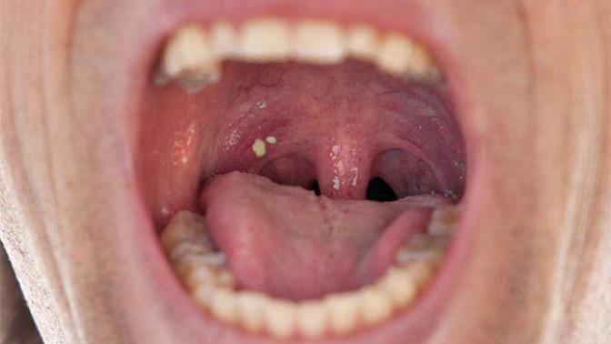 Increased amount of tonsil stones?