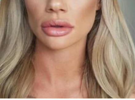 Men and women, do you find lip fillers attractive?