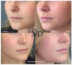 Do you find lip fillers attractive question for women and men?