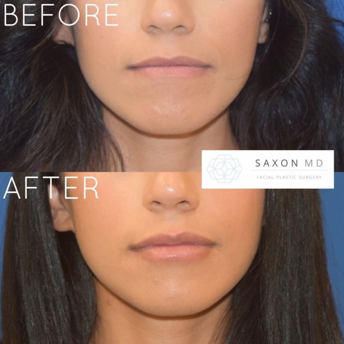 Do you find lip fillers attractive question for women and men?