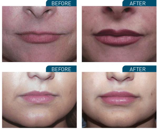 Do you find lip fillers attractive question for women and men?